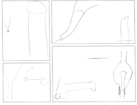 Dyspareunie et vaginisme. SYMPTÔMES VOISINS, SYMPTÔMES COUSINS… Dyspareunie et vaginisme. SYMPTÔMES VOISINS, SYMPTÔMES COUSINS…